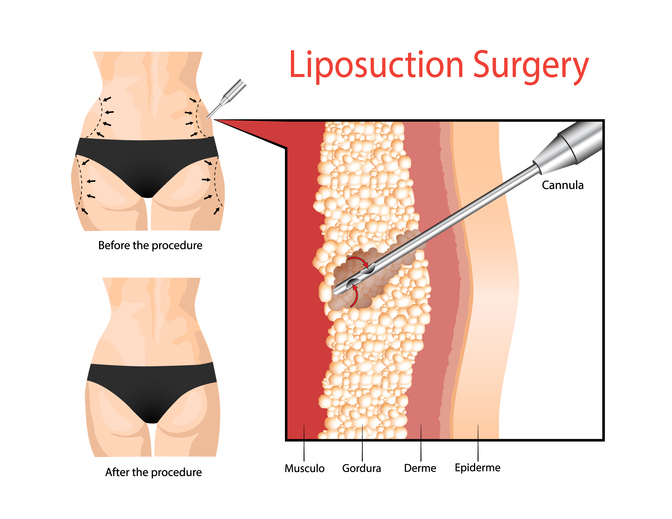 شفط الدهون بالفيزر 3 Liposuction Surgery