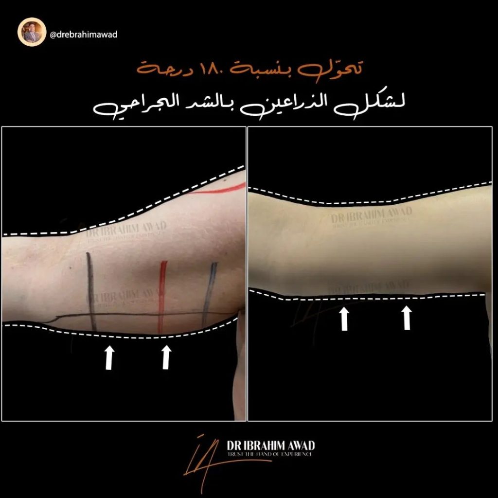 شد ترهلات الذراعين 7 drebrahimawad 1731771545081 Copy Copy