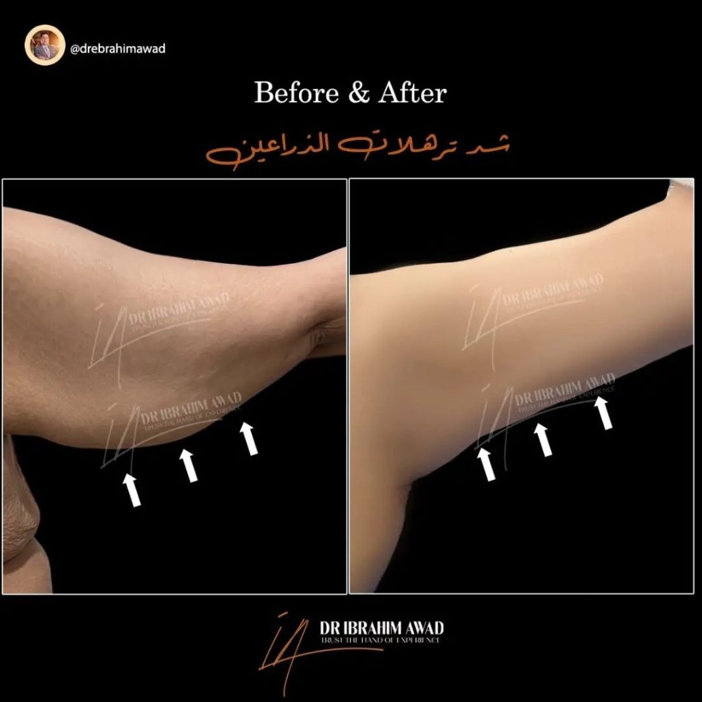 شد ترهلات الذراعين 8 drebrahimawad 1731771561232 Copy