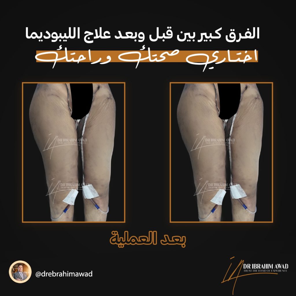 الليبوديما أسبابها وطرق العلاج 6 0a6ae3a5 f1d5 4bca b7b4 1238b3df61d2