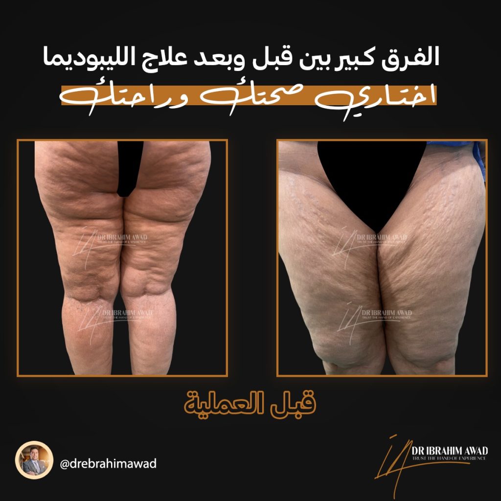 الليبوديما أسبابها وطرق العلاج 4 66620ac9 9b73 480a 81ba 0925dce8479d