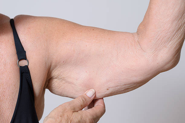 شد ترهلات الذراعين 1 istockphoto 481098958 612x612 1