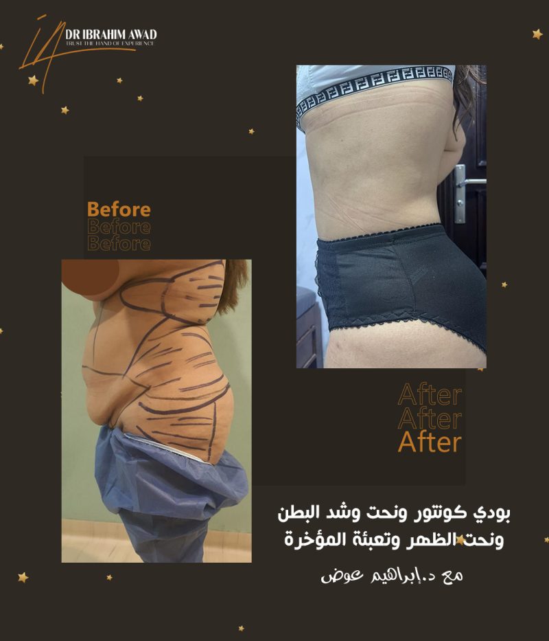 نتائج عملية نحت الجسم دائمة