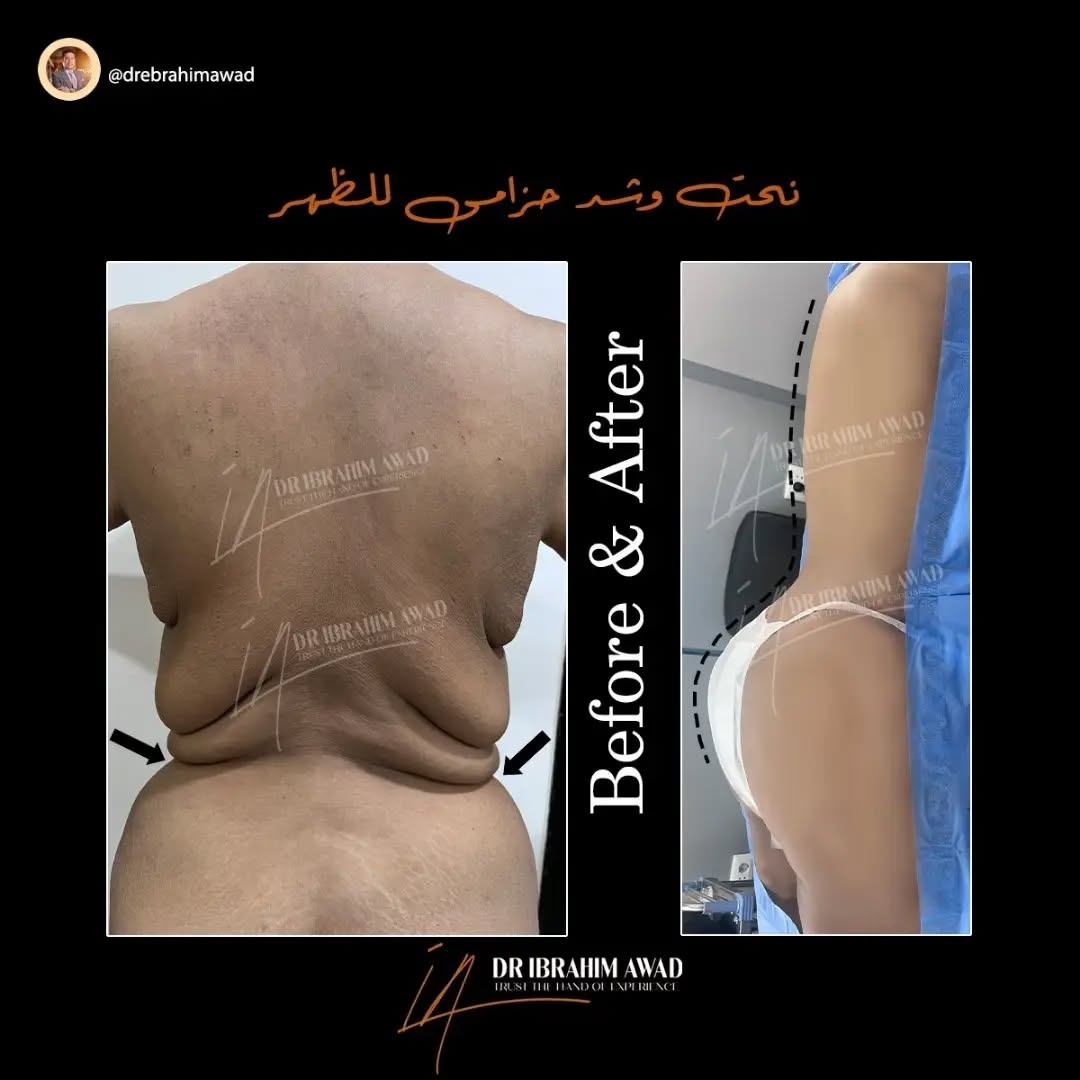 مخاطر واضرار عمليات نحت الجسم