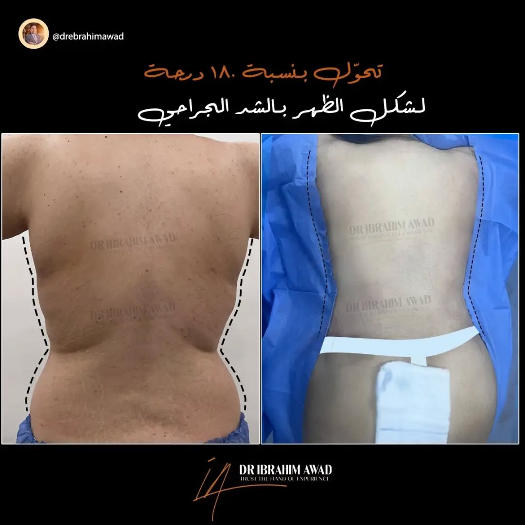 شد ترهلات الجسم والبطن