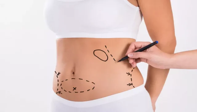 شد ترهلات الجسم والبطن بأحدث التقنيات لعام 2025 4 شد ترهلات الجسم والبطن